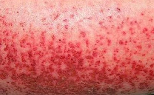 Test nhanh sốt xuất huyết NovaTrend: Cập nhật tình hình & cách xử trí sớm 1